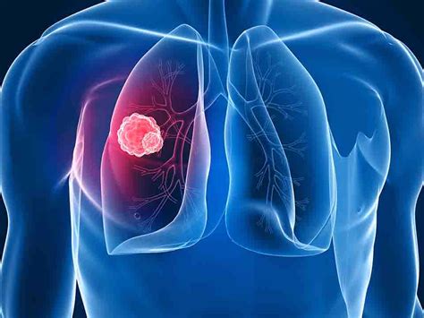 一、中央型肺癌的CT表现-肺癌综合治疗-医学