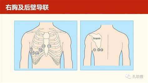 心电图连接示意图图片