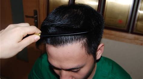 在北京植头发多少钱?植发的原理是什么?_千颜网