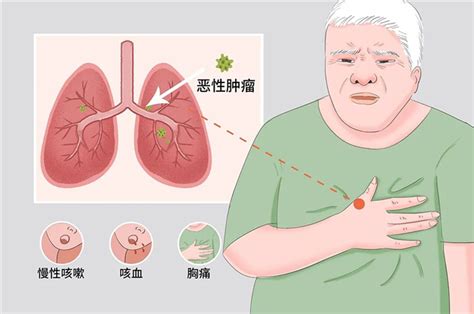 【肿瘤防治宣传周】疫情期间，肺癌患者实用宝典--衢州市人民医院