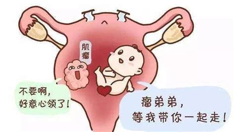【医学小常识】你不可不知的妇科秘密—子宫肌瘤会影响怀孕吗？ 健康课堂 -北京中医药大学东方医院