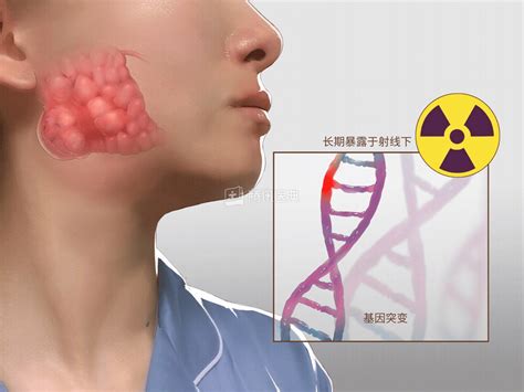 腮腺肿瘤早期图片
