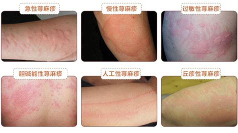 南京治疗荨麻疹最快最好是哪个医院 - 南京华肤皮肤病医院