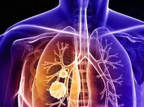 什么样的肺小结节需要抗炎治疗？抗炎治疗的关键是什么？三种类型的肺结节应对方法各不相同！-科普头条-看呼吸