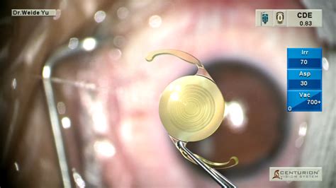 深圳首批三焦点散光人工晶体植入手术在希玛眼科医院完成_深圳新闻网