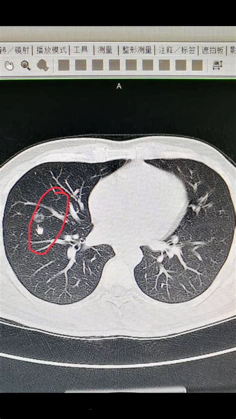 肺癌的ct影像学表现,肺的t图片,肺t图片影像学_大山谷图库