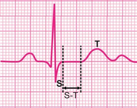 心电图ST段压低的类型和意义 - 微医（挂号网）