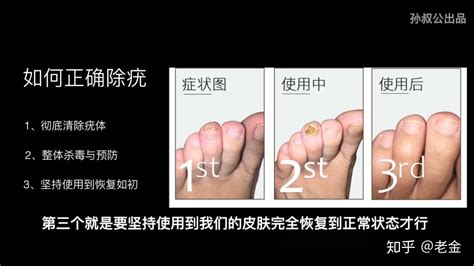 治疗跖疣的方法有哪些_跖疣_北京京城皮肤医院(北京医保定点机构)
