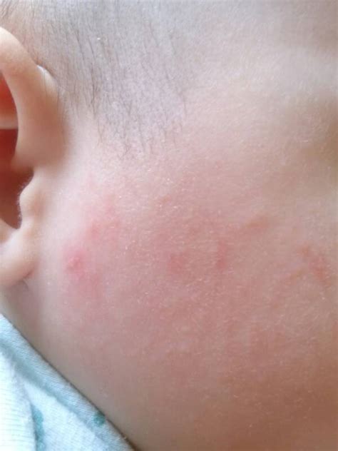 小孩发烧身上出现红斑,发后出红疹图片,身上起红斑痒图片_大山谷图库