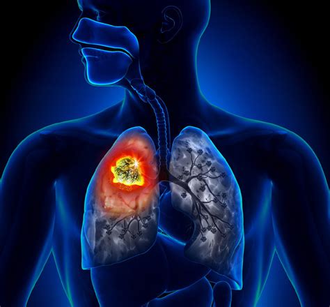 癌细胞在体内变性！肺腺癌靶向治疗耐药后竟然变成了小细胞肺癌 - 微医（挂号网）
