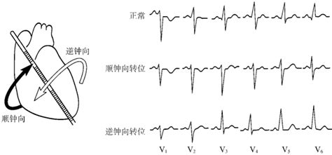 干货丨不同起源室性早搏的心电图表现及定位__凤凰网