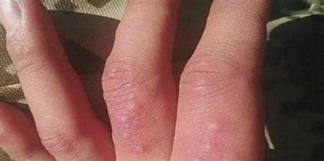 求诊症状：本人手指上长水泡，反复发作，会自愈。水泡透明的，针眼样的长满手指，中医看了说是湿疹。。。。_360问答