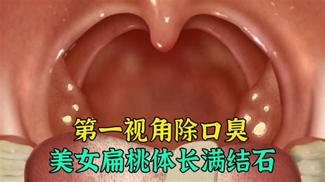 扁桃体结石图片