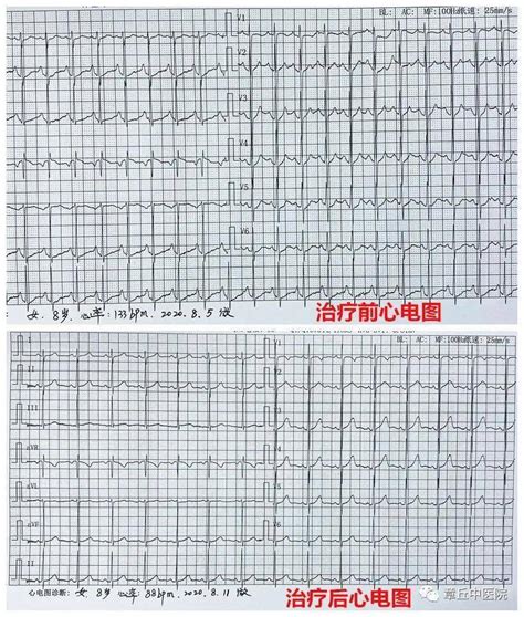 心电图入门图片