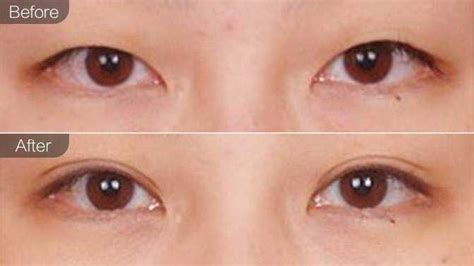 朴钟哲做眼睛怎么样?朴钟哲眼整形和眼修复很出名且质保3年,眼部对比照-8682赴韩整形网