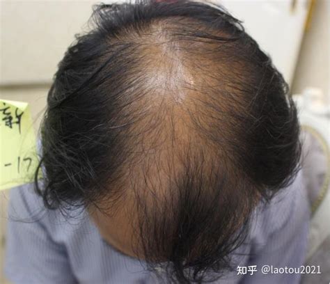 如果脱发怎么办怎么治疗再生发呢？ – 生发垂直网