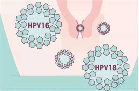 感 染HPV高危16和18哪个更严重？ - 知乎
