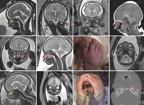 MRI诊断2例胎儿Pierre Robin序列征