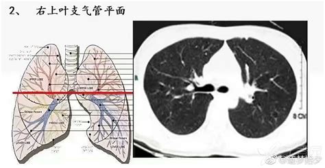 胸部正常CT解剖结构 - 爱爱医医学网