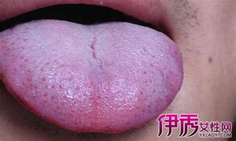 芒刺舌图片