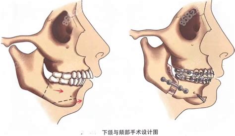 正颌手术到底是什么？怎么做的？请看正颌手术术式全解析,颌面对比照-8682赴韩整形网