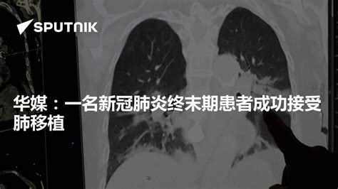 华媒：一名新冠肺炎终末期患者成功接受肺移植 - 2020年5月12日, 俄罗斯卫星通讯社