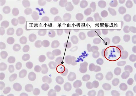 一问医答 | 原发免疫性血小板减少症（ITP）常见问题（四） - 知乎