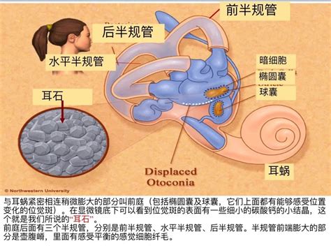 耳石症图片