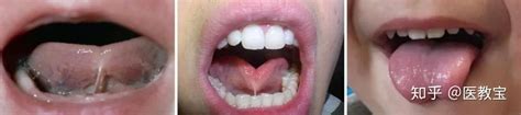 常见的四种舌象－齿痕舌-别有病 Byb.cn-纯自然疗法 攻克亚健康