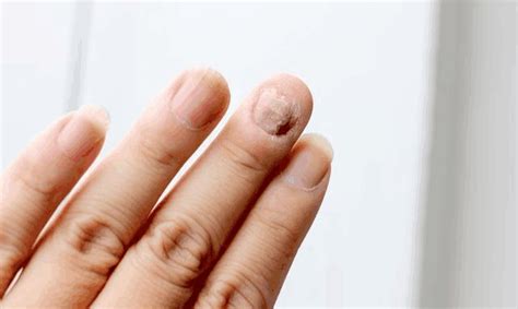 “一个传染俩”的灰指甲该如何预防？_澎湃号·湃客_澎湃新闻-The Paper