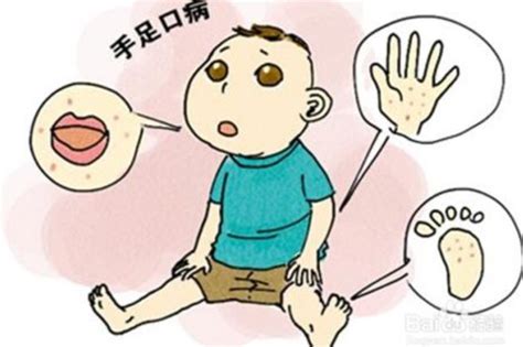 轻微手足口病图片