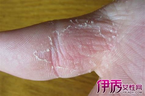 治疗手脱皮的药膏儿童小孩成人手心真菌感染脚干裂蜕皮抑菌汗疱疹-淘宝网