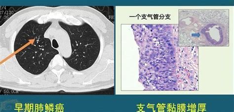 肺鳞癌是怎么发生的？怎样早期发现？医生教你看CT片|新冠肺炎_新浪新闻