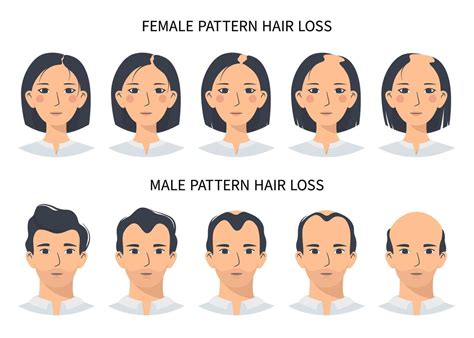 Etapas de pérdida de cabello, patrón de alopecia androgenética ...