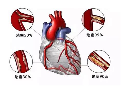 让堵塞的心脏血管重焕“生机”，心内科专家教你建立侧支循环！