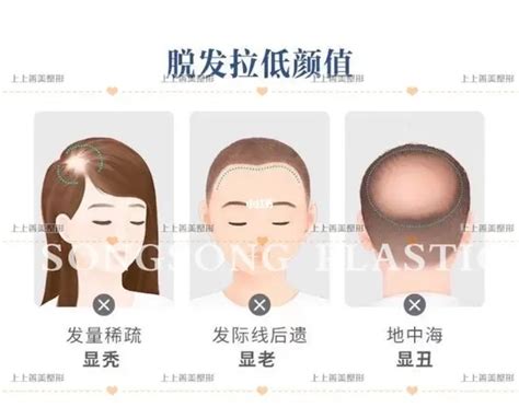 上海种植头发注意事项有哪些_上海美莱整形医院