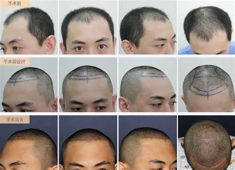我在深圳倍生植了发，3000单位头顶植发，花费三万元看看效果贵不贵-发友网