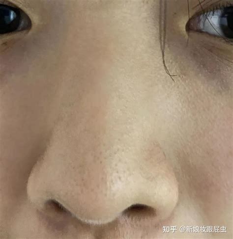 脸上油脂粒堵塞、毛孔粗大怎么办？皮肤科医生教你1招解决毛孔粗大的办法，清除油脂粒、收缩毛孔、细腻肌肤一步到位！ - 知乎