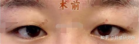 上海九院做双眼皮开眼角整形医生 眼部综合 价格案例分享攻略 - 知乎