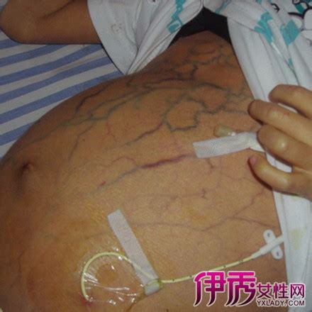 轻度肚子腹水图片