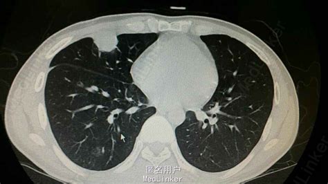 肺的分叶和分段详细图,肺门位置图片大全,肺叶分段_大山谷图库