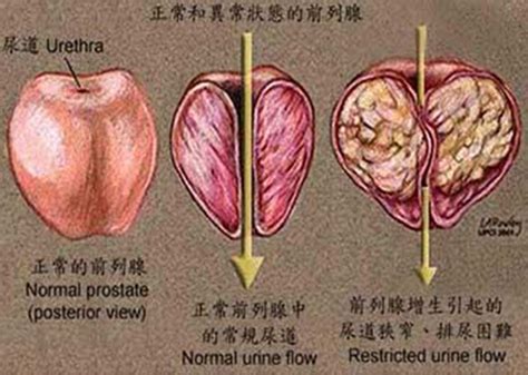 良性前列腺增生症 泌尿外科 -首都医科大学附属北京佑安医院