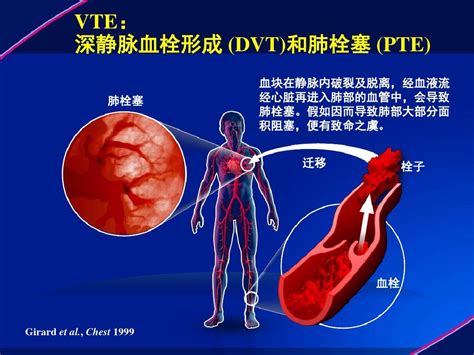 以临床实用性为主，注重落地实施——2020中国VTE防治大会明日召开-会议-呼吸界