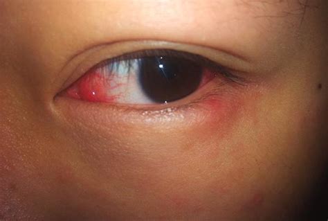 眼睛出现以下症状，可能是肝血不足，最好去医院检查下