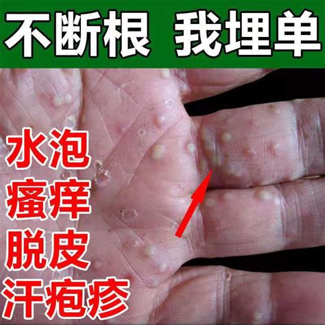 汗疱疹油手藓癣药膏真菌感染湿疹手脱皮手部克星治疗手上水泡手部-淘宝网