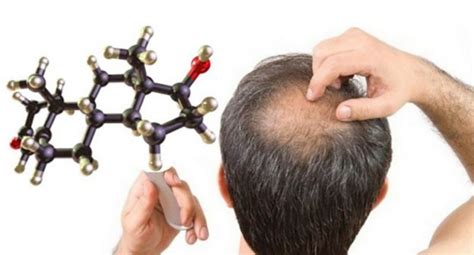 脱发的原因有哪些呢？什么原因会导致脱发？ – 生发垂直网