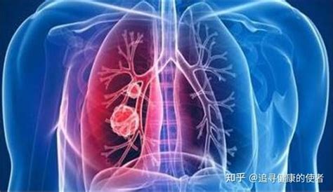 肺癌早期的体征与常见表现 - 知乎