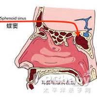 鼻窦炎图片