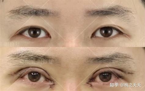北京全切双眼皮修复，术后一年长期反馈。 - 知乎