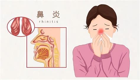 关于过敏性鼻炎，这些知识你一定要了解一下 - 知乎
